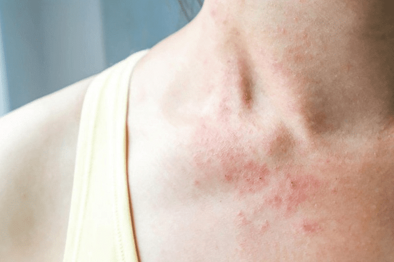 máy lọc không khí ion âm có thể giúp làm giảm tỉ lệ dị ứng